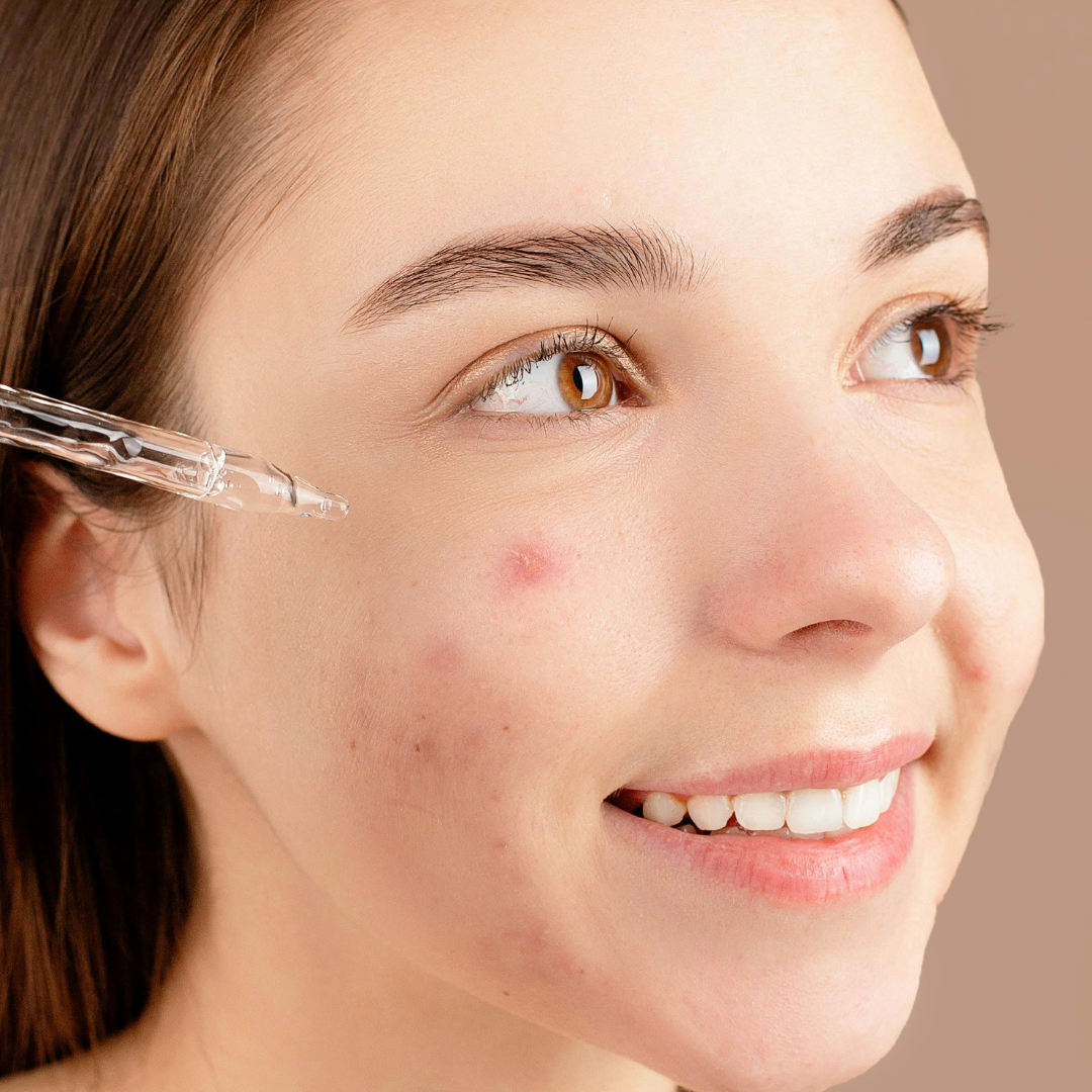 Salicylic Acid Face Serum for Acne – Complete Guide