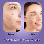 2% Salicylic Acid Face Serum with Niacinamide, Zinc PCA & Acne Buster